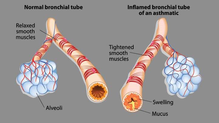 asthma brochial tubes